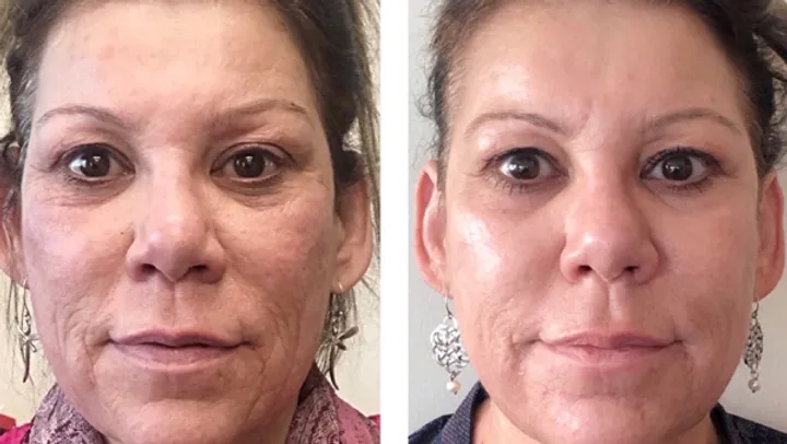 Scarlet RF Microneedling Event at Skindale Medspa