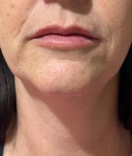 Skindale Medspa before & after