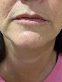 Skindale Medspa before & after