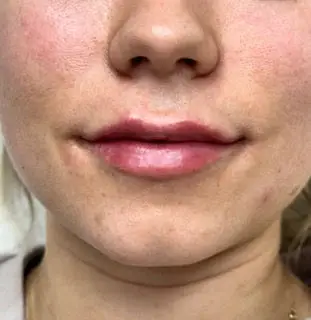 Skindale Medspa before & after