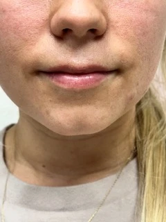 Skindale Medspa before & after