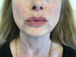 Skindale Medspa before & after
