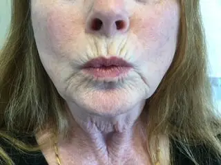 Skindale Medspa before & after