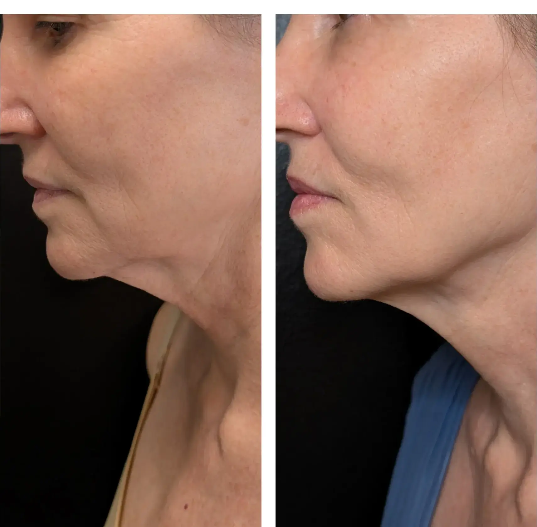 Scarlet RF Before & After (2)