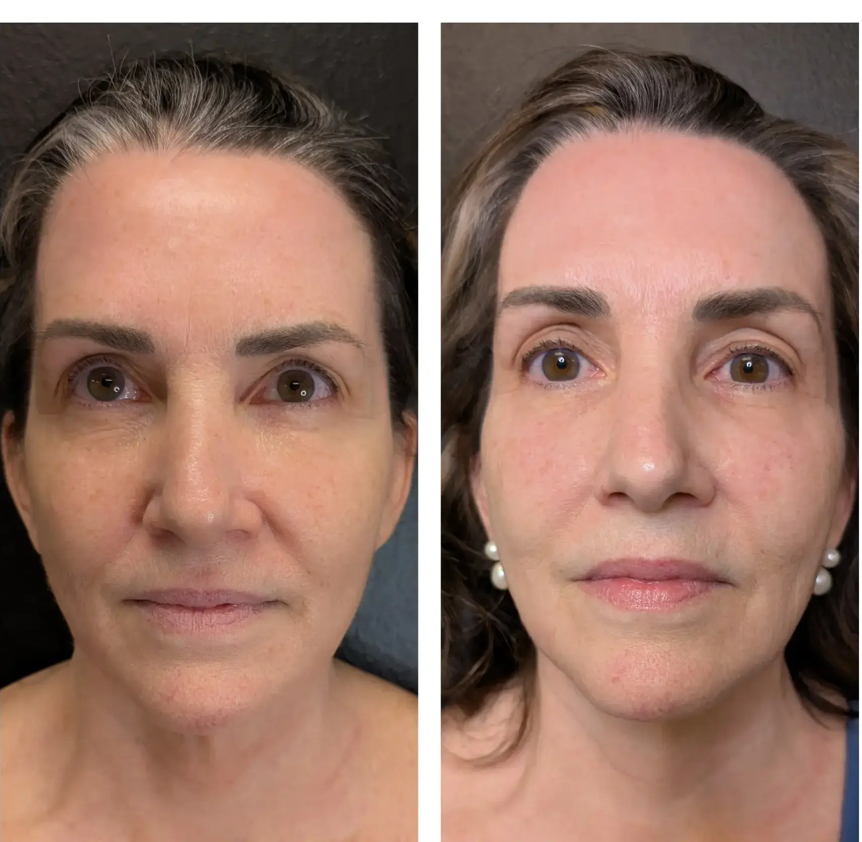 Scarlet RF Before & After (3)