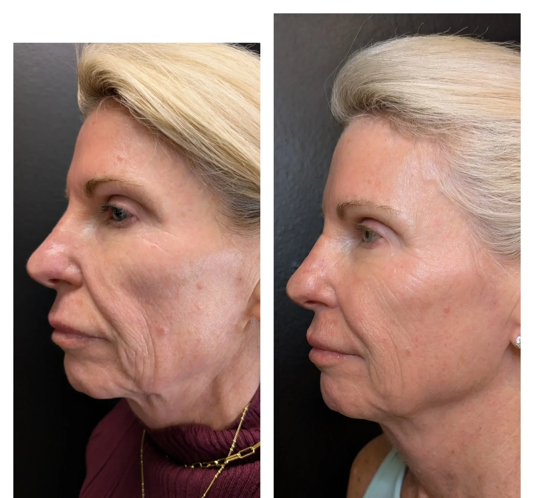 Scarlet RF Before & After (4)