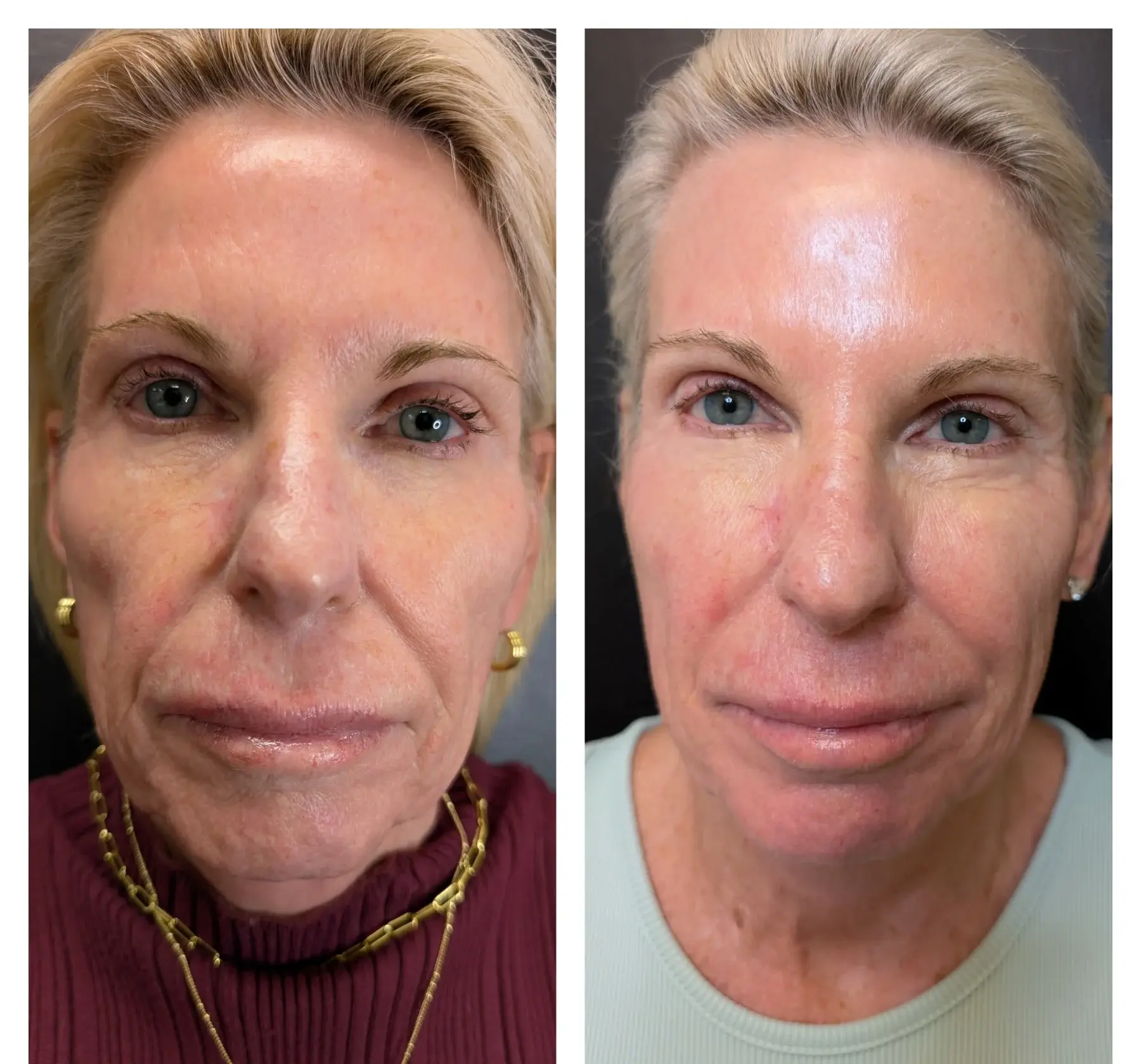 Scarlet RF Before & After (5)