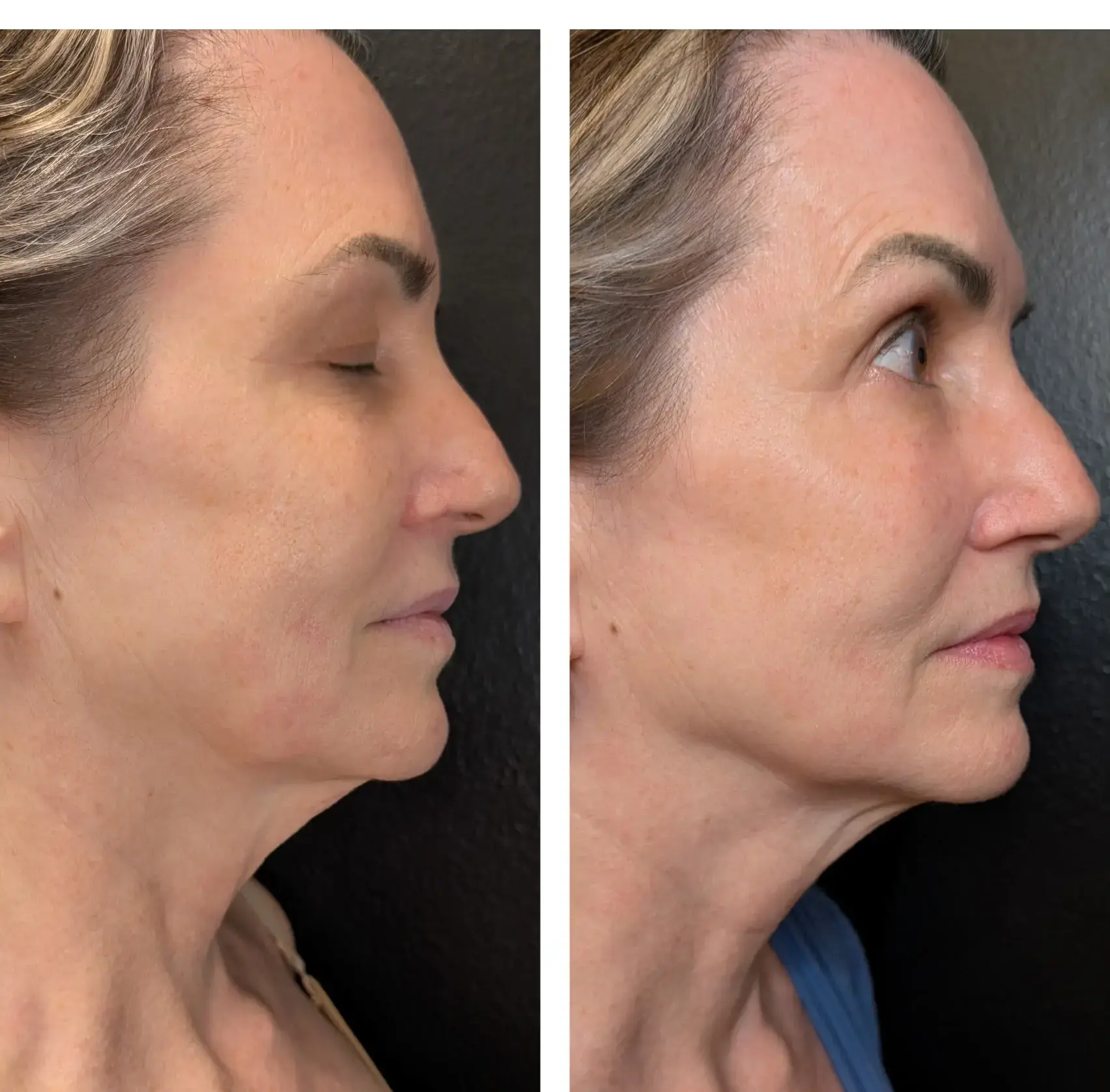 Scarlet RF Before & After