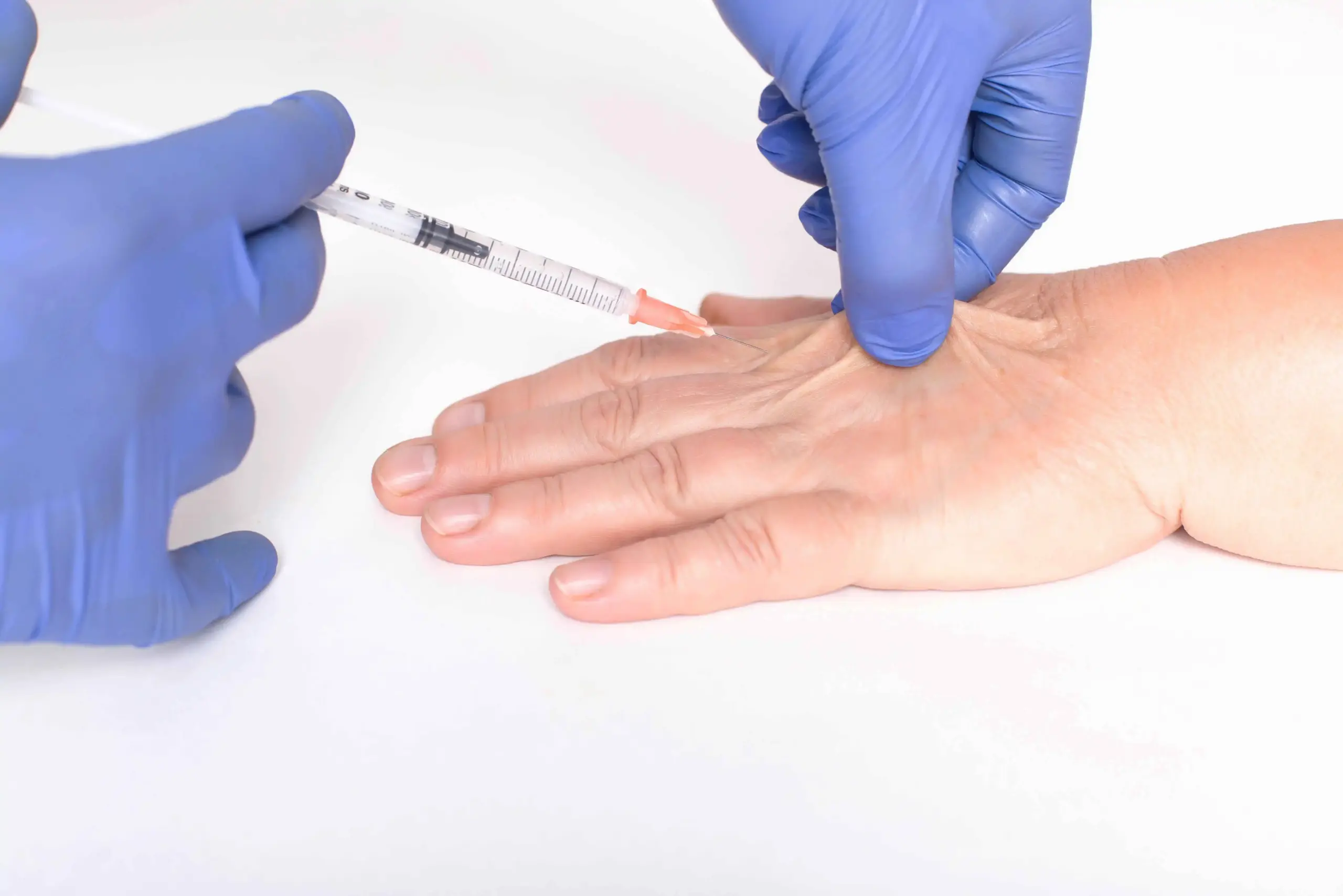 Dermal Fillers for Hands