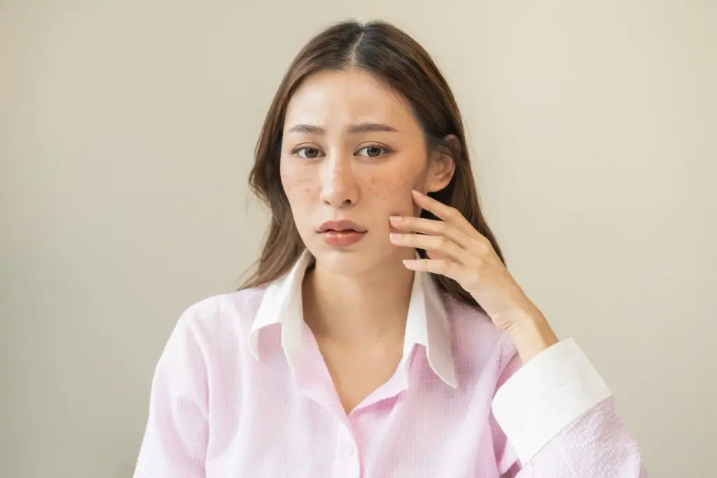 Melasma Correction